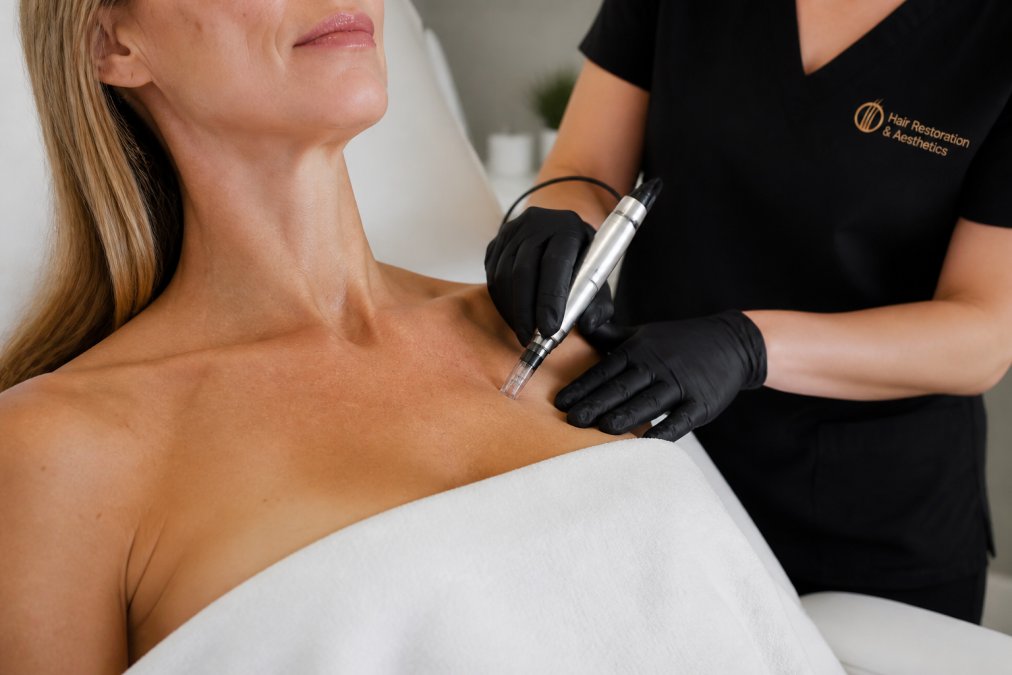 Close-up of a woman's décolletage area in a bright, modern aesthetic clinic, with a gloved practitioner's hands holding a microneedling pen device near the skin, soft natural lighting, professional medical setting