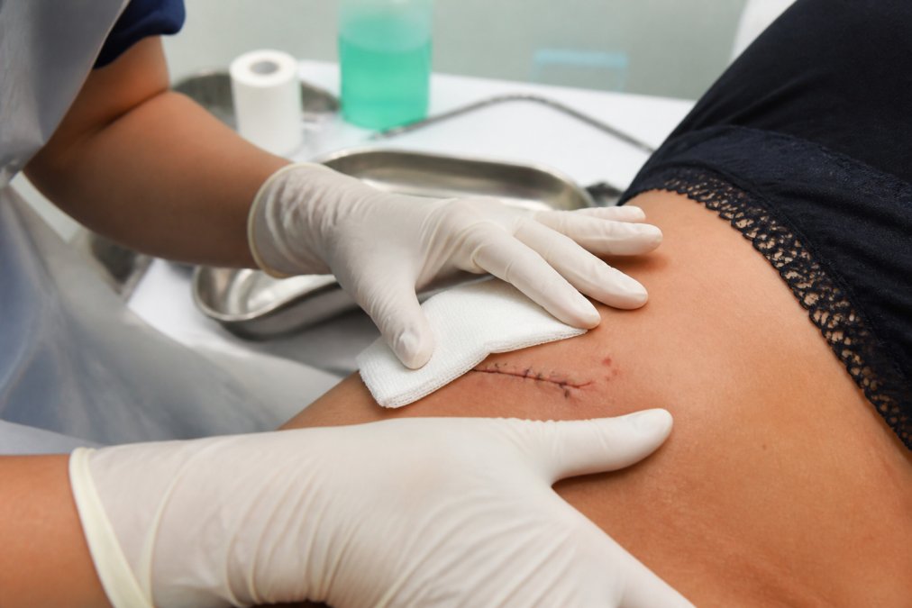 Healthcare professional's hands carefully examining a small surgical site on a patient's skin with sterile gauze and medical instruments visible