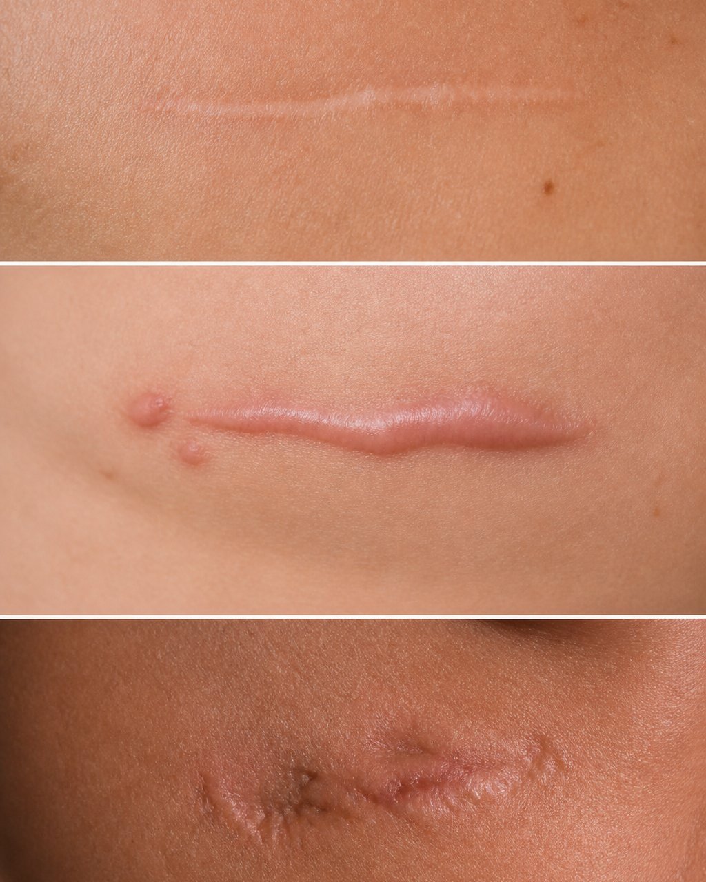 Close-up of different scar types on skin showing flat scars, raised scars, and textured scars in natural lighting to illustrate scar characteristics