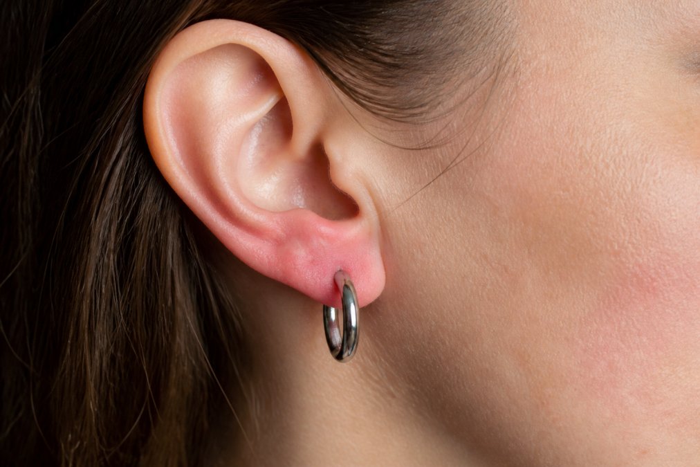 Close-up of a person's ear showing mild redness and irritation from wearing jewelry, with a stainless steel earring visible