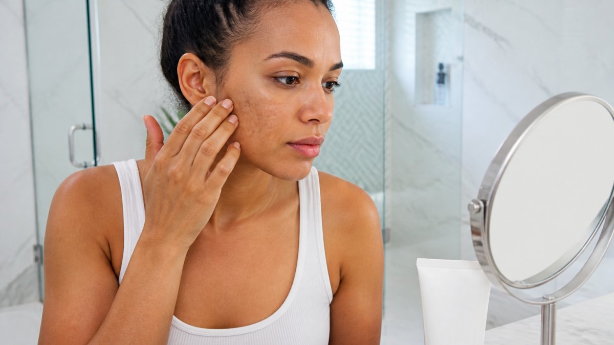 Is Sunscreen Enough for Existing Hyperpigmentation?