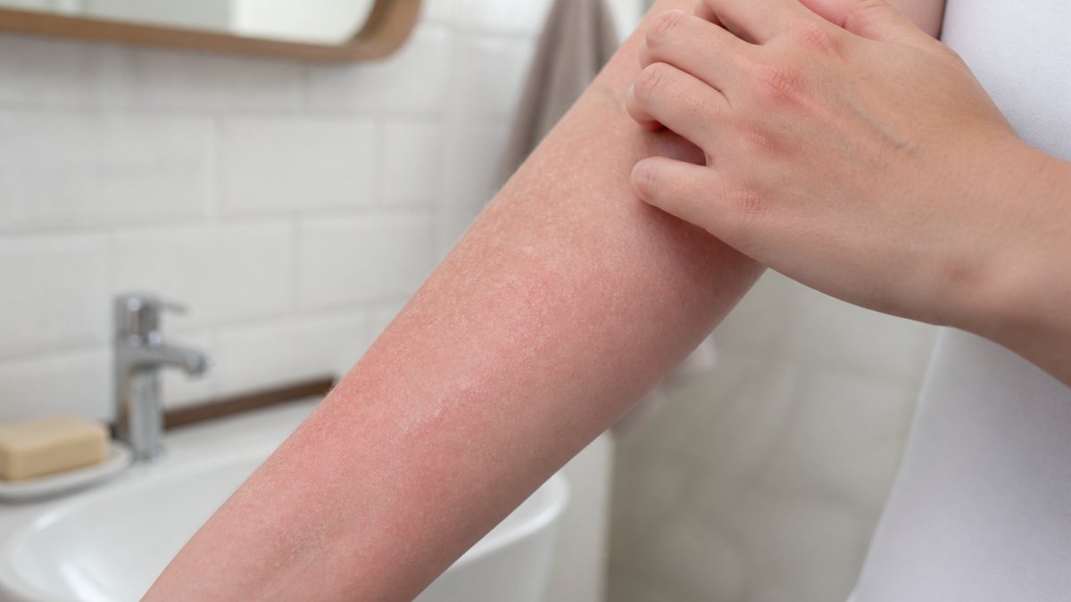 Close-up of a person's arm showing dry, irritated skin with visible tightness and slight redness, demonstrating hard water skin irritation under natural bathroom lighting