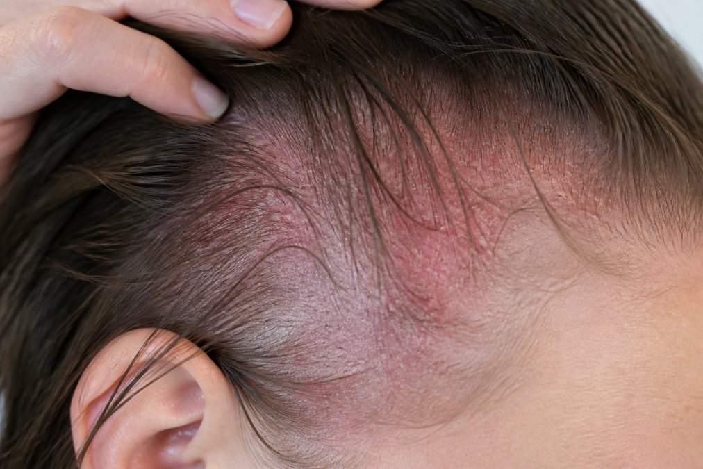 Close-up of woman's scalp showing visible redness and irritation with inflamed skin, demonstrating allergic dermatitis reaction from keratin treatment application