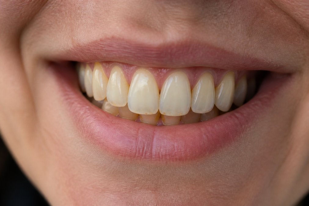 Close-up of a person's smile showing visible yellowing at the gum line where dentin is exposed, with subtle wear patterns on the biting surfaces of front teeth in natural daylight