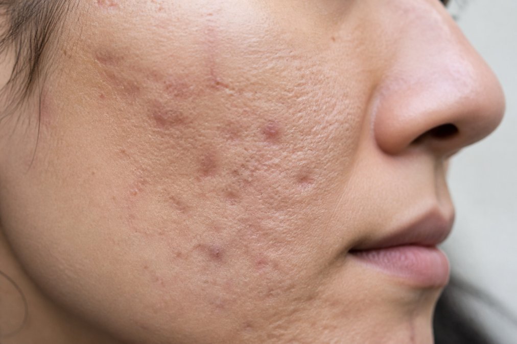 Close-up of skin showing different acne scar textures including depressed pitting and raised areas on a person's cheek, demonstrating various scar types under natural lighting
