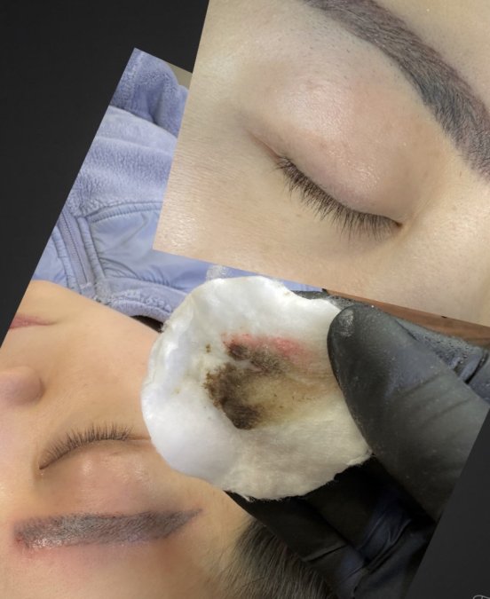 Permanent Makeup Removal Services in Olympia