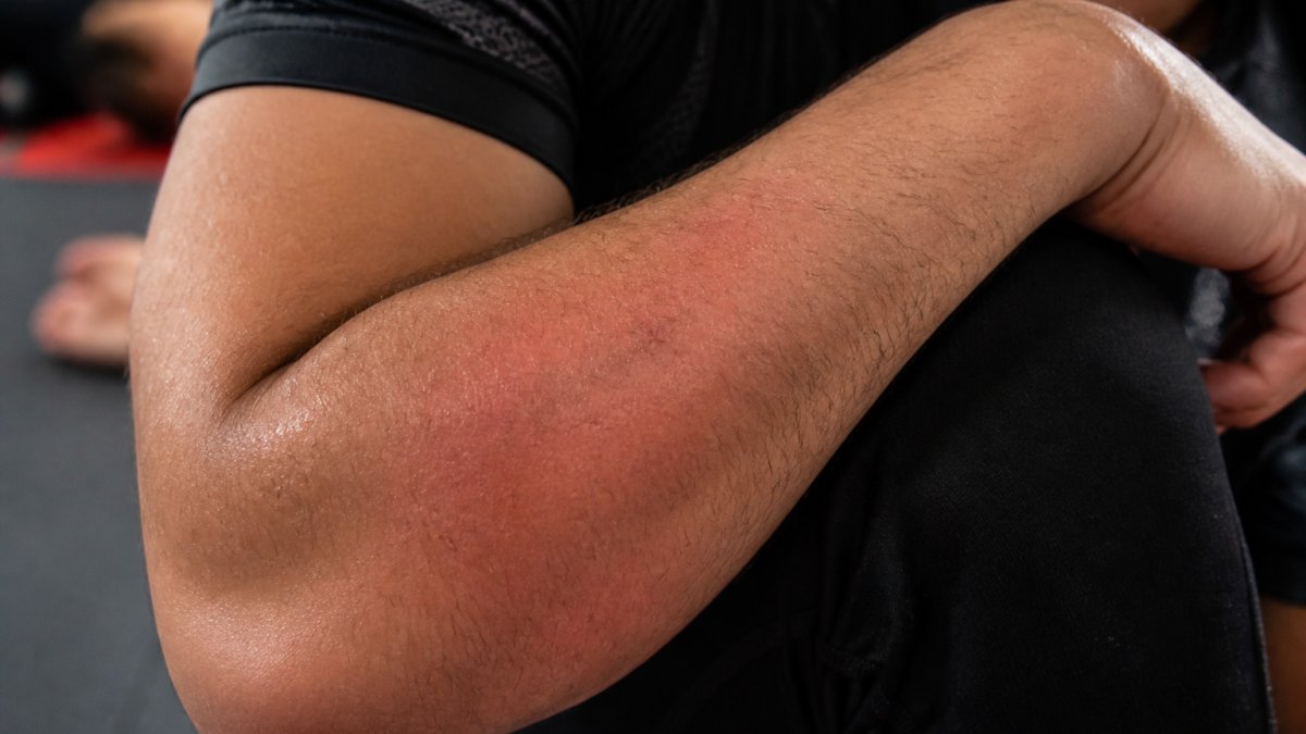 Infographic identifying early signs of skin infection like redness and swelling on an athlete's arm.