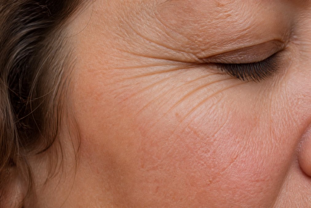 Close-up of skin texture showing fine lines and wrinkles under natural daylight, demonstrating the type of detail needed for accurate before-and-after comparison