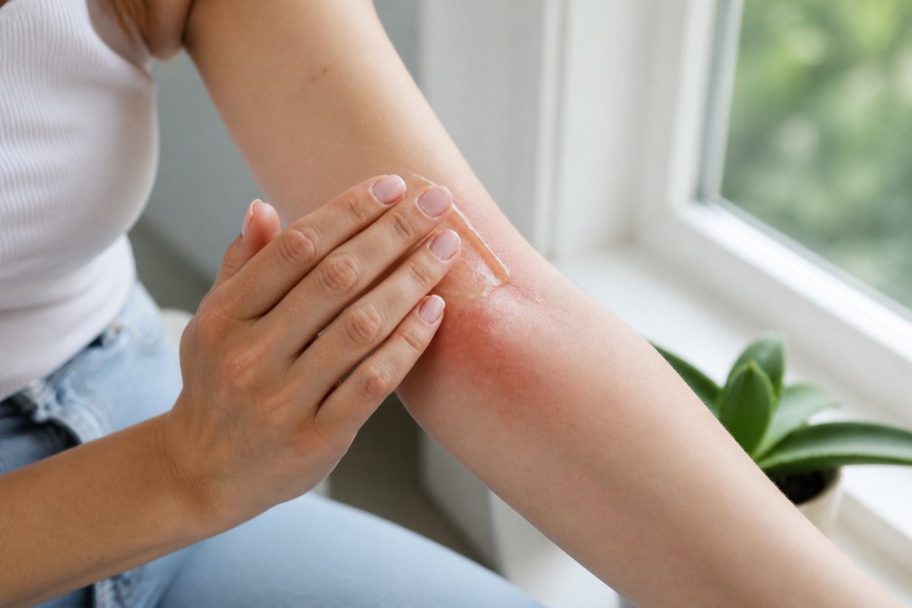Tæt billede af hænder, der forsigtigt påfører klar aloe vera gel på rødlig, irriteret hud på en arm, med naturligt lys fra et vindue