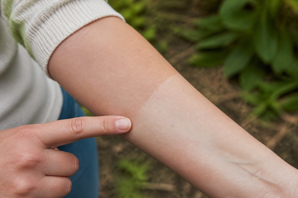 Close-up of a person's inner forearm showing a small test application of insect repellent with a clear demarcation line between treated and untreated skin, photographed in natural daylight