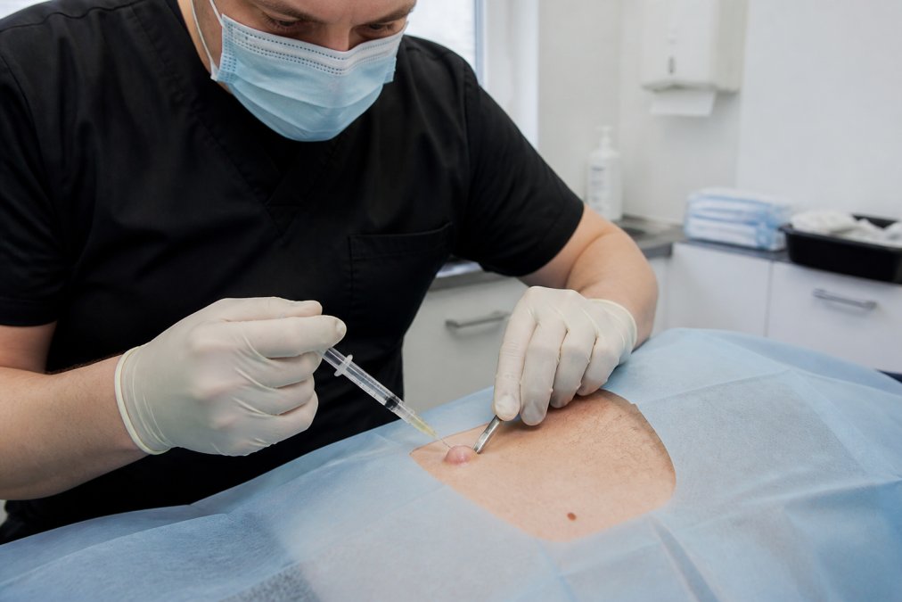Professional illustration showing Professional for sebaceous cyst removal vs drainage