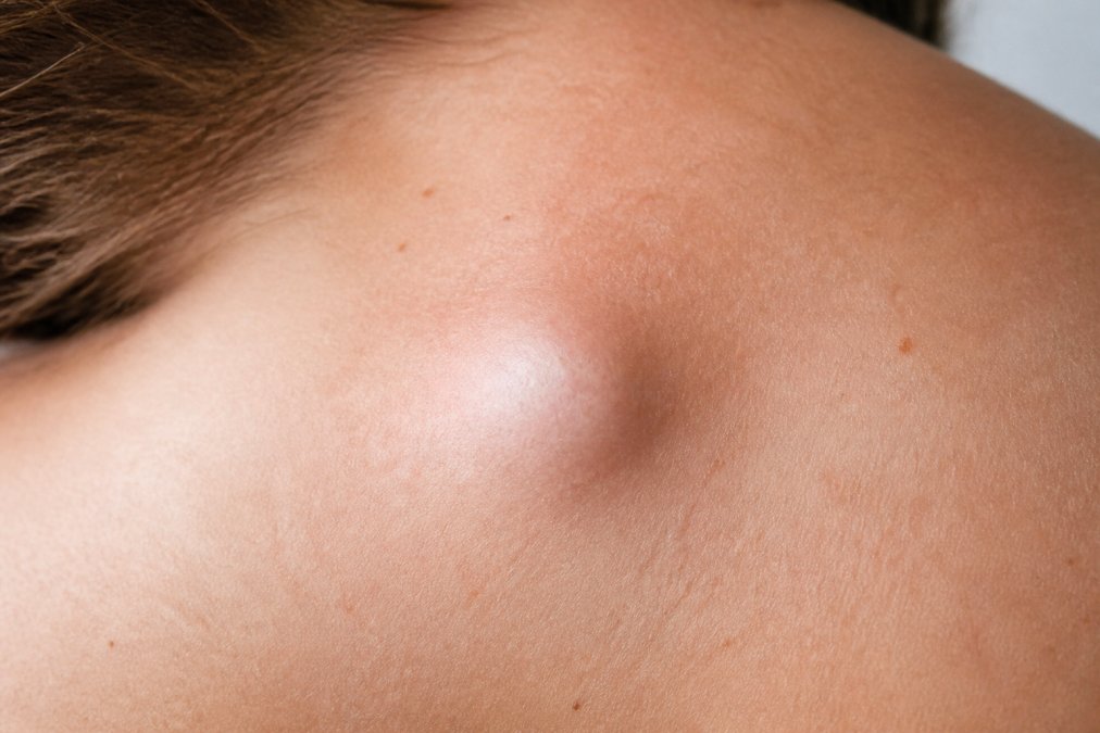 Close-up of a subcutaneous lump on skin surface showing a benign sebaceous cyst with clear definition and well-lit for educational purposes