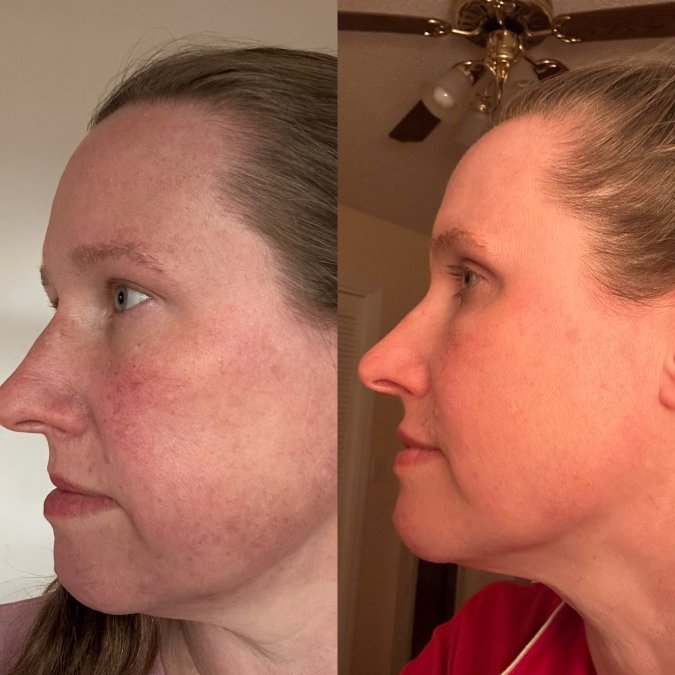 How to Maintain Botox Results Longer: 2026 Guide