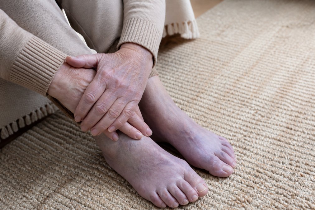 Infographic illustrating pale and bluish skin tones as key signs of poor blood circulation in hands and feet