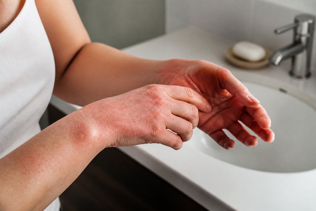 Close-up photo of a person's hands and forearms showing mild redness and dry, flaky patches of skin after washing, with a bathroom sink and soap dish visible in the soft-focus background