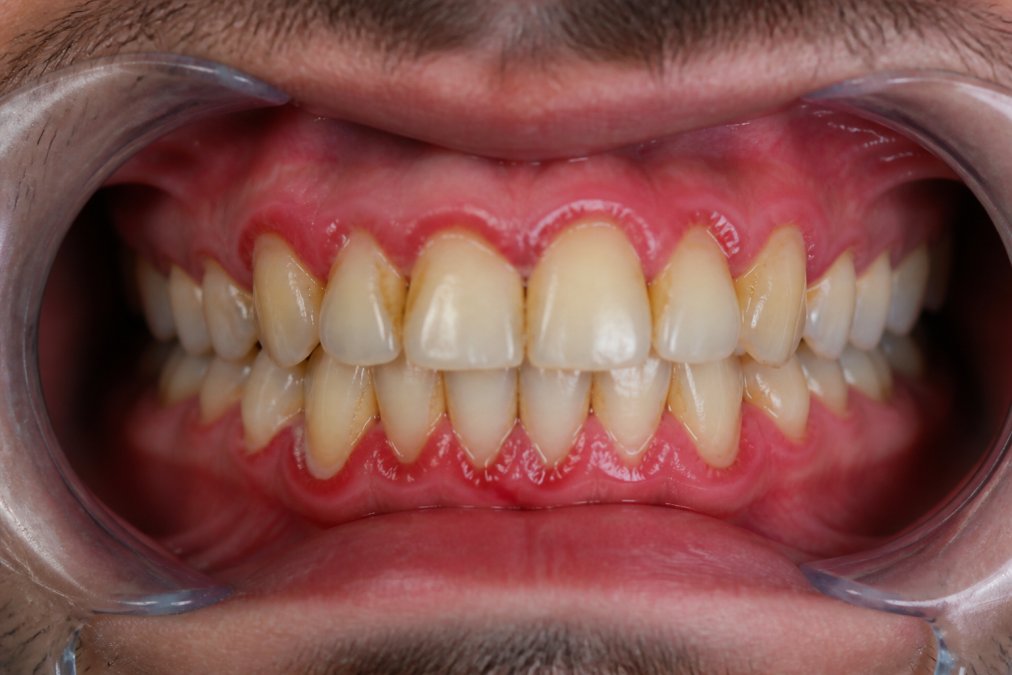 Close-up of a person's mouth showing visible plaque buildup on teeth and gum inflammation with natural lighting highlighting dental concerns
