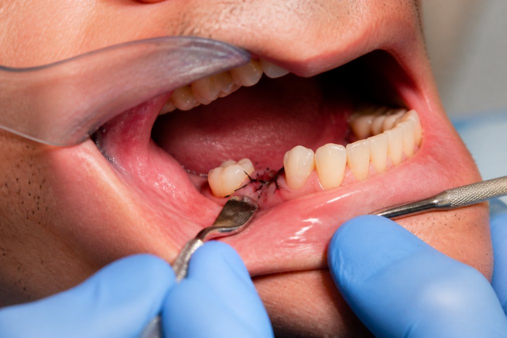 Close-up of a patient's mouth during post-operative examination, showing the surgical site with sutures and early healing tissue, under clinical examination lighting