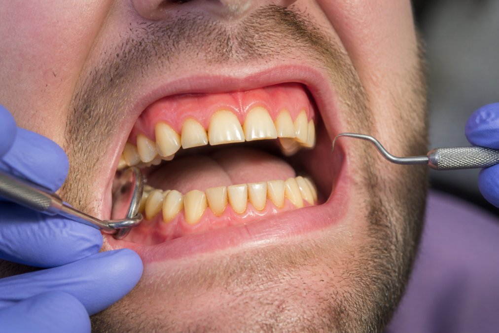 Close-up of a patient's mouth during dental examination showing visible wear patterns on teeth, jaw tension, and gum inflammation under clinical lighting