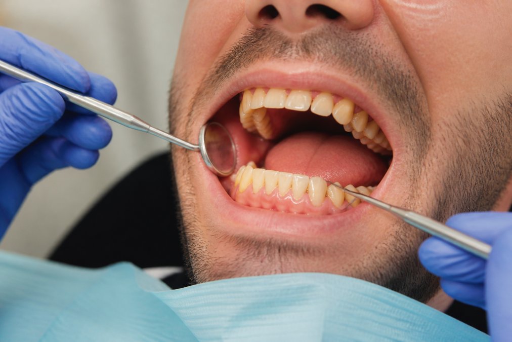 Professional illustration showing sleep apnea dental health