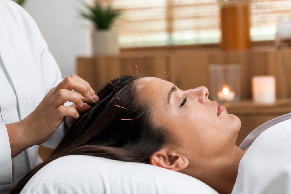 Infographic showing how acupuncture needles target follicles to treat female alopecia in a clinical setting.