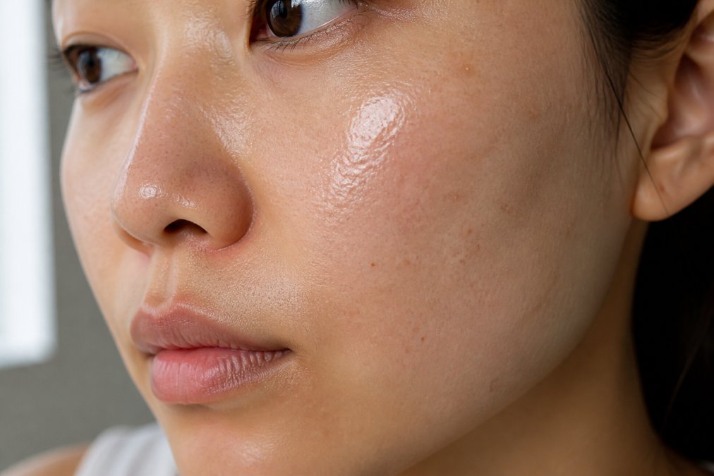 Close-up of a person's face showing oily skin texture with visible pore congestion and shine, photographed under natural window lighting