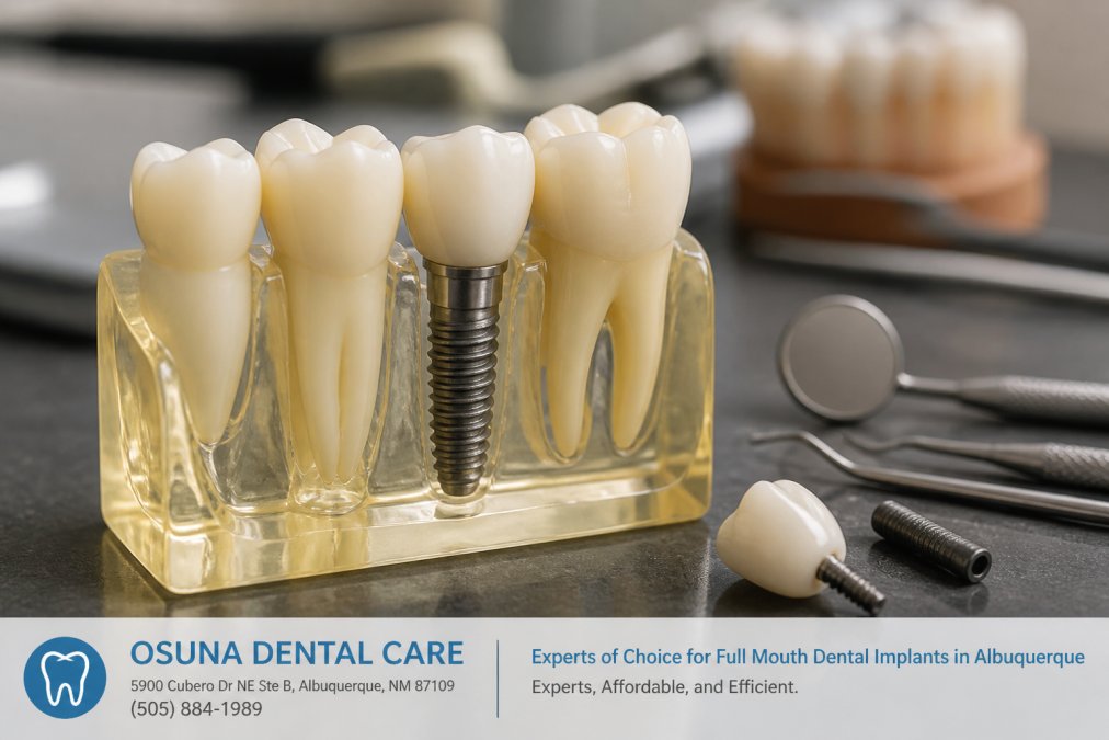 Top 5 Dental Implant Procedure Steps
