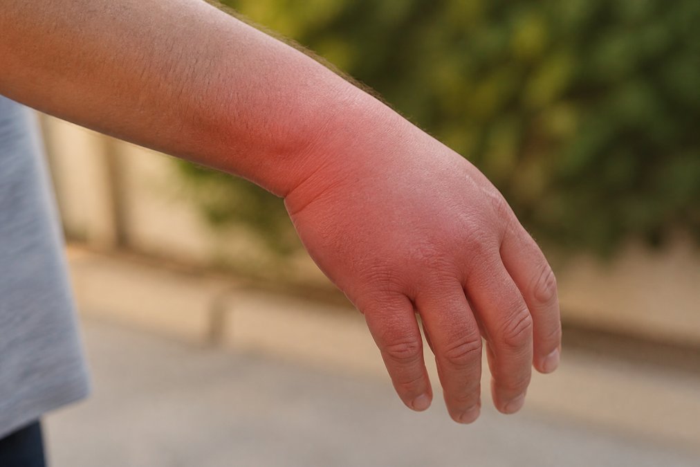 Close-up of a person's swollen wrist and hand showing visible inflammation and discomfort before applying a compression sleeve, photographed in natural daylight