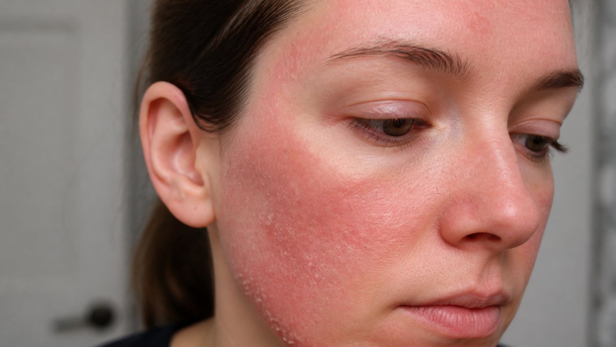 Close-up of person's face showing visible redness, dry patches, and irritated texture on cheeks and forehead with uneven skin tone
