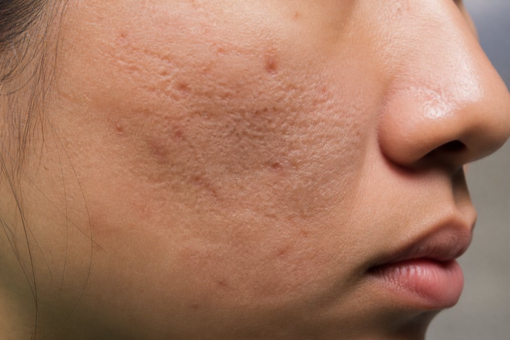 Close-up of skin showing varied acne scar textures including depressed pitting and raised areas on facial surface under clinical lighting