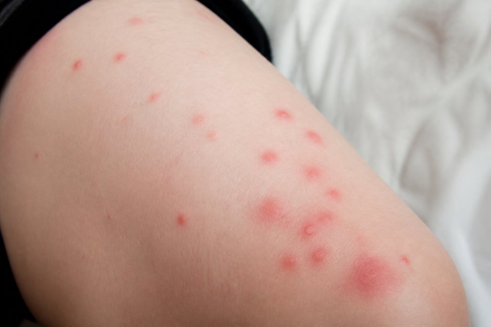 Close-up of bed bug bites showing red welts and clusters on human skin, with inflammation visible on pale skin under natural lighting