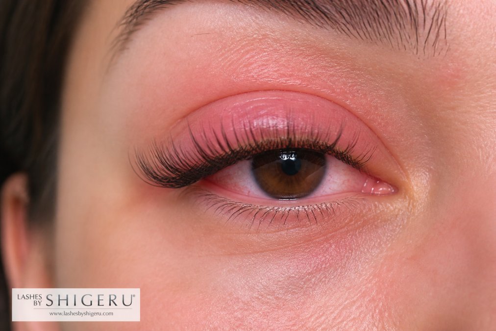 Close-up of eye showing mild redness and slight swelling around eyelid area after lash extension application, with natural lighting highlighting the irritated tissue
