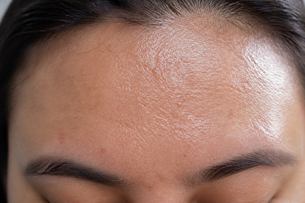 Close-up of oily skin texture on the face showing enlarged pores and sebum buildup on the forehead under natural lighting