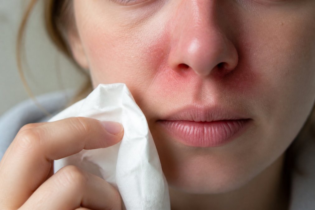 Close-up of a person's face showing redness and irritation around the nasal passages, with a tissue held nearby in soft natural lighting