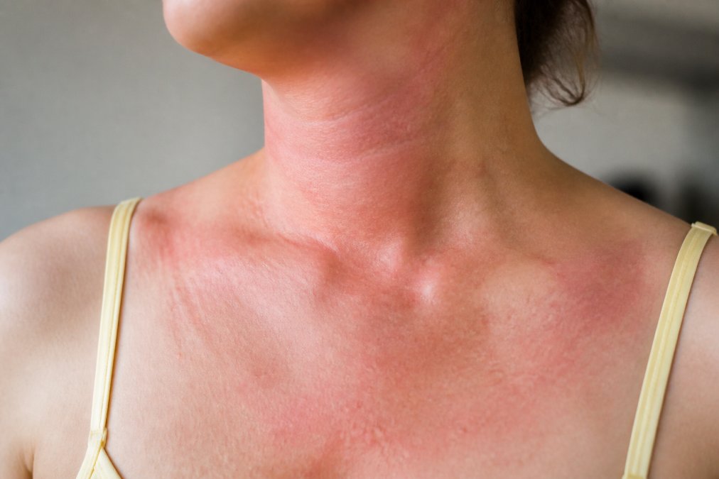 Close-up of redness and irritation on a person's neck and chest area showing contact dermatitis inflammation from fragrance exposure, natural daylight lighting
